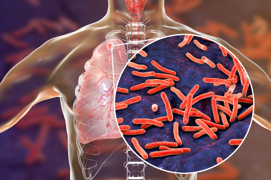 what causes tuberculosis pdf