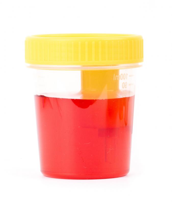 urine sample only detects urethral infection