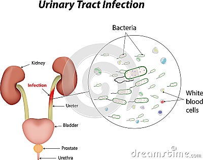 urine sample only detects urethral infection